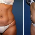 Cómo se realiza la liposucción: Guía completa y detallada del proceso en España