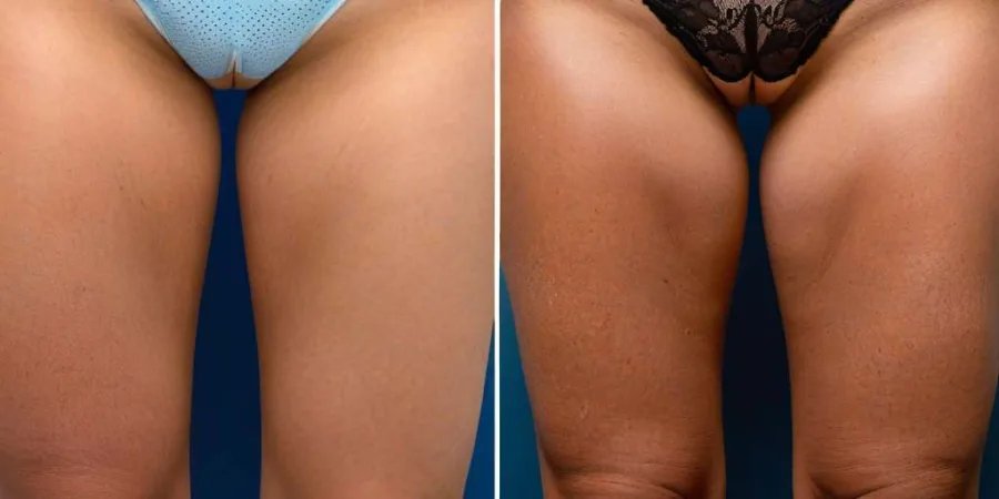 Tratamiento de estrías: ¡Reserva tu consulta hoy mismo en GH Clinics Madrid!