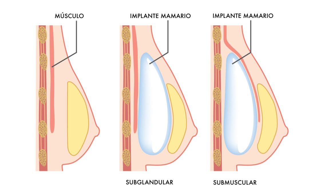 Aumento de pecho por vía submamaria: Consulta en GH Clinics Madrid ahora