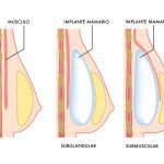 aumento de pecho por vía submamamria